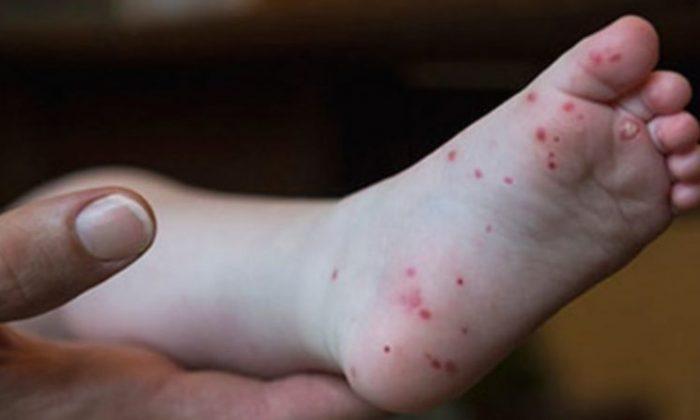 Contagious Illness That Affects Children Spreading in Virginia, Doctors Warn