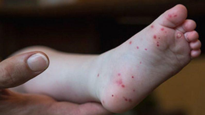 Contagious Illness That Affects Children Spreading in Virginia, Doctors Warn