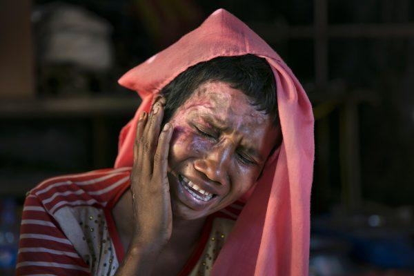 Rohingya refugee Mumtaz Begum, 30, becomes emotional as she touches the wounds she received when the military set her house on fire after raping her and killing her husband in the Aug. 25 attack on the Tula Toli village in Burma. The photo was taken on Dec. 2, 2017, in Cox's Bazar, Bangladesh. (Allison Joyce/Getty Images)