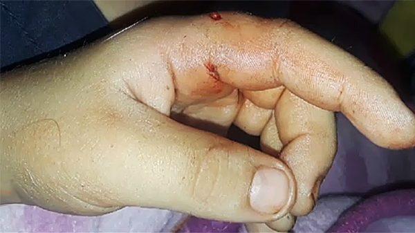 The raccoon bit Chandler’s hand, possibly spreading the rabies virus. (Fox screenshot)