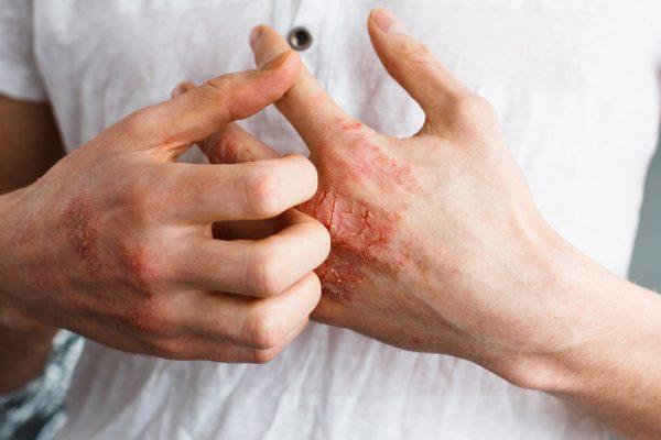 Eczema causes not only itchiness, but also redness and infections. (Ternavskaia Olga Alibec/Shutterstock)