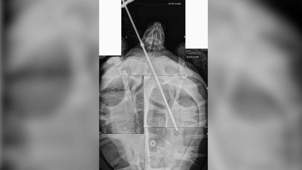 X-ray from the sea turtle found with a 3-foot-long spear in its neck near Key Largo in Marathon, Florida, on Sept. 7, 2019 (Turtle Hospital)