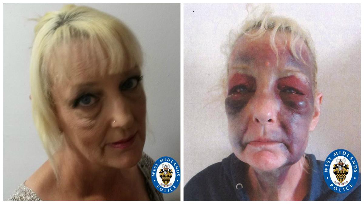 Lynn Hart, 53, suffered horrific extensive bruising on her face and body after being assaulted by her boyfriend. (Courtesy of West Midland Police)