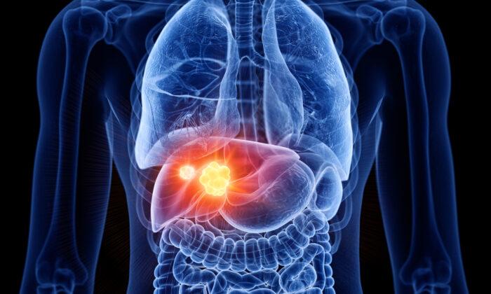 Main Causes of Liver Cancer and How to Prevent
