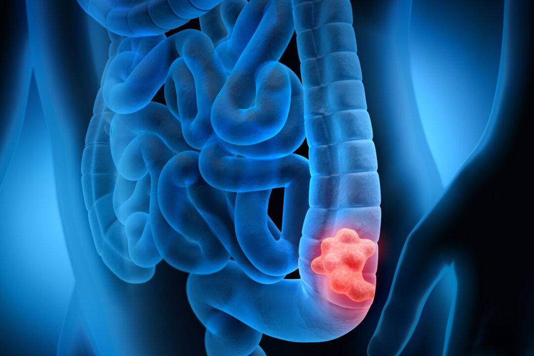 Colonoscopy: Unexpected Results From a Major Study, Is It Worth Doing?