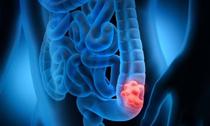 Research Finds Safer Way to Detect Colon Polyps