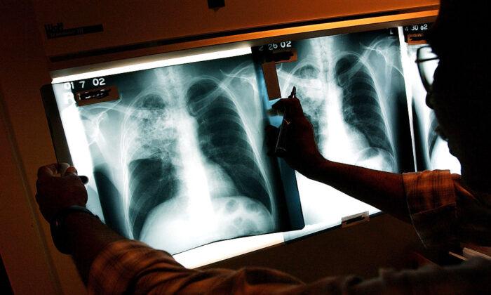 ‘Urgent Situation’: 500 Children Possibly Exposed to Tuberculosis