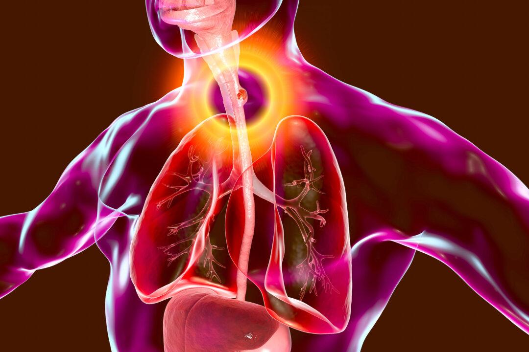 Esophageal Cancer: 1 of Least Studied Common Cancers, 5 Ways to Prevent