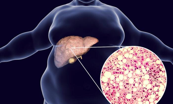 Study: Diet High in Sugar, Fat Produces Bacterium That Triggers Fatty Liver Disease