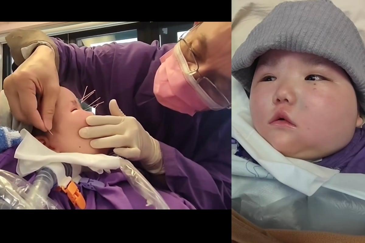 7-Year-Old Girl in Vegetative State Blinks for the First Time in 3 Years After Acupuncture Treatment