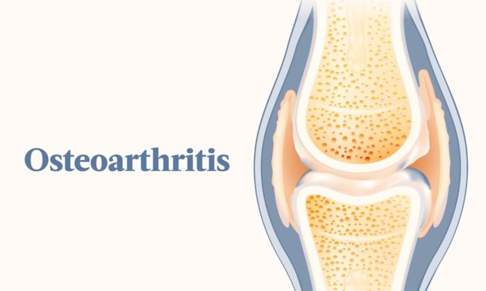 Osteoarthritis: Symptoms, Causes, Treatments, and Natural Approaches