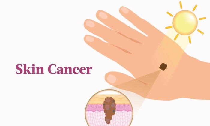 Skin Cancer: Symptoms, Causes, Treatments, and Natural Approaches