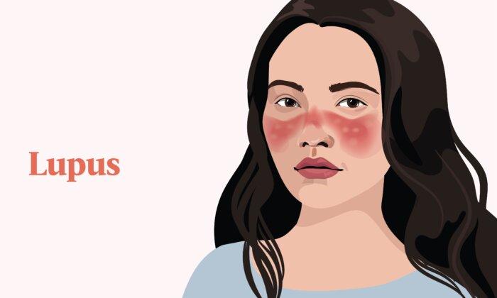 Lupus: Symptoms, Causes, Treatments, and Natural Approaches