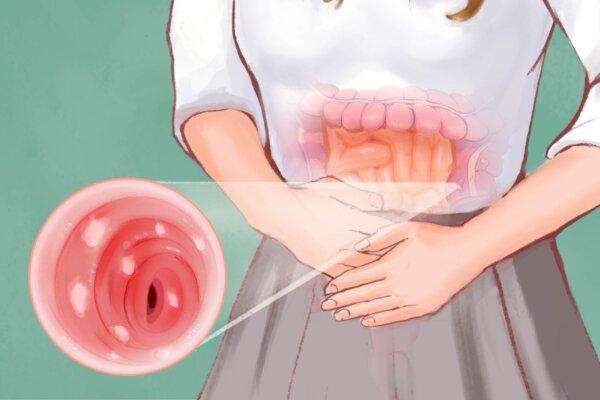Ulcerative Colitis: Symptoms, Causes, Treatments, and Natural Approaches
