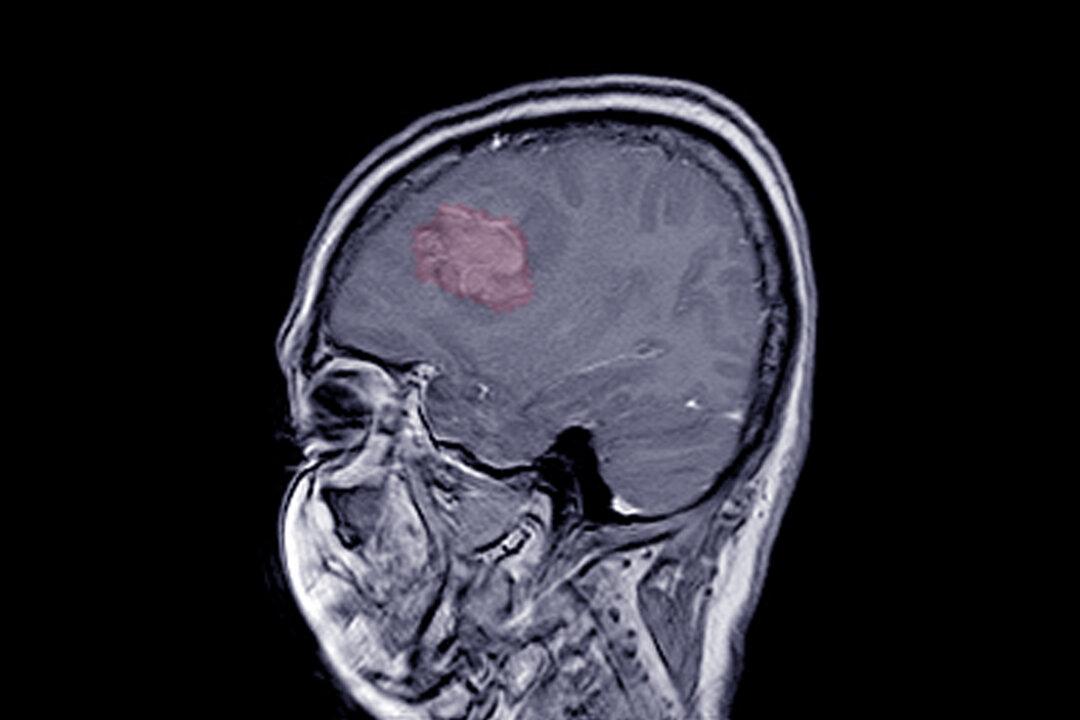 Certain Progestogens Linked to Higher Risk of Brain Tumors, Study Finds