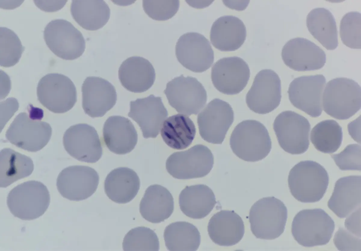 Southeastern Ontario Health Unit Probes 114 Cases of Parasitic Stomach Illness