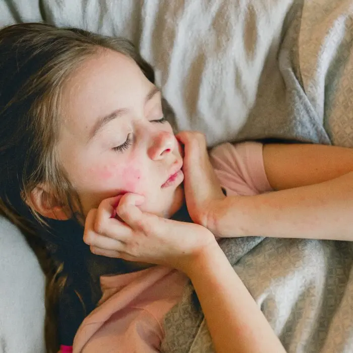 Eczema Is More Than ‘Dry Skin’: 5 Practical Tips You Can Apply