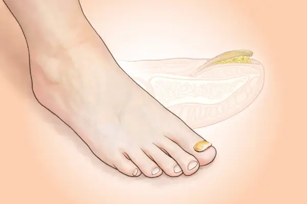 Toenail Fungus: A Stubborn Infection Affecting 1 in 10 People–Signs to Watch For
