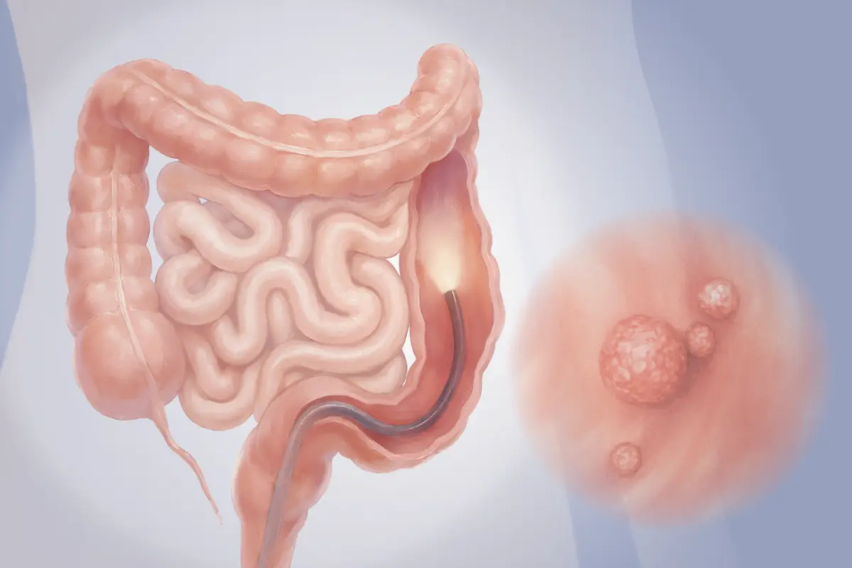 Colonoscopy: The Most Used Screening Test for Colon Cancer, Here Are the Benefits and Risks