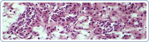 Parasite in Eyeball Nearly Blinds Florida Teen