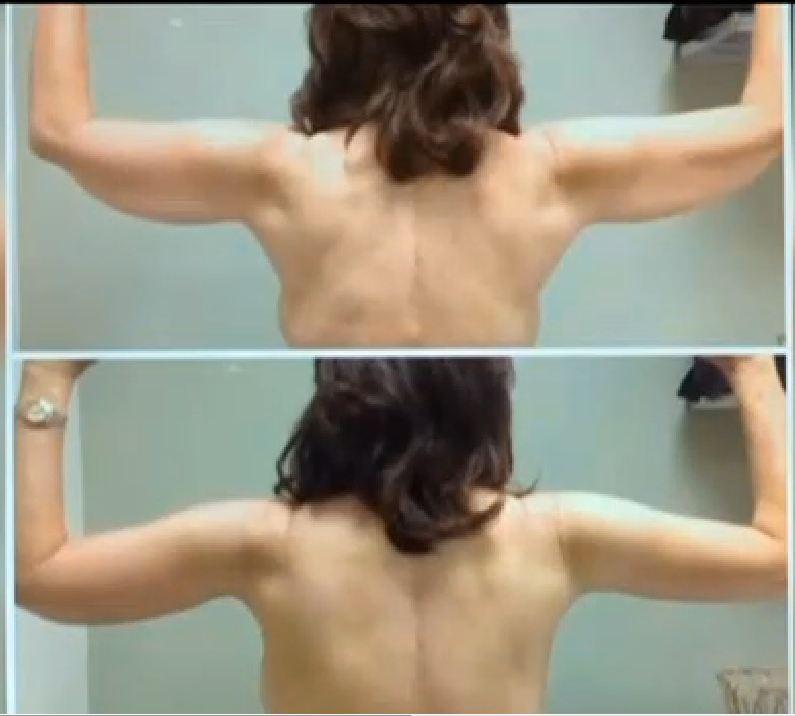 Arm Lift Surgery Got Popular Fast (+Photo)