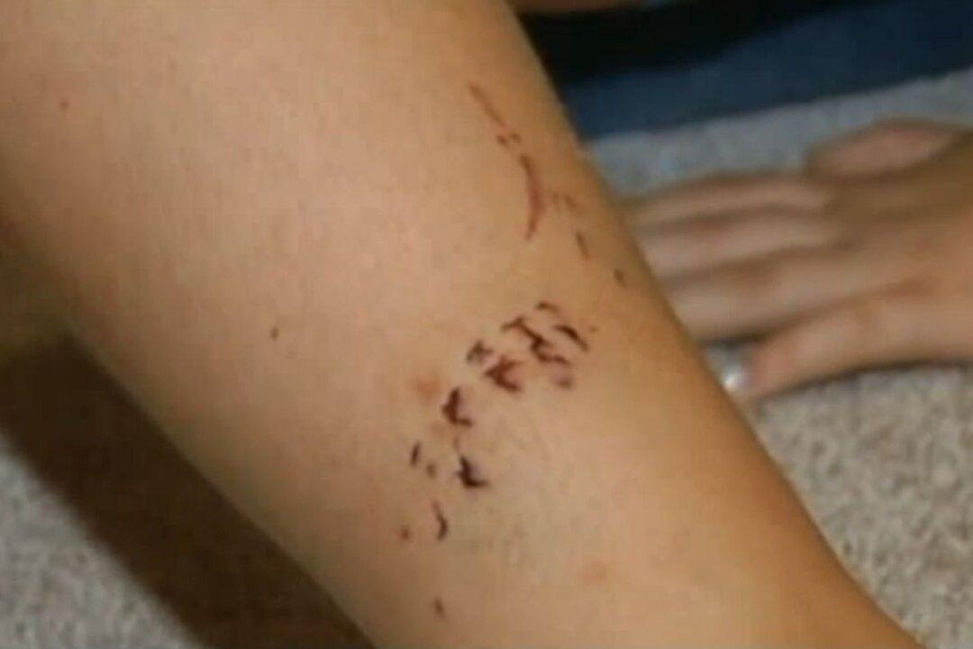 Shark Attack: Tooth Will be Kept as Souvenir by Riley Breihan, 11