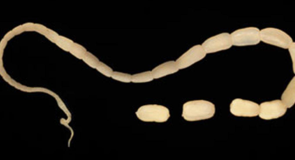 Florida Man Diagnosed With Pork Tapeworm Inside Left Eye