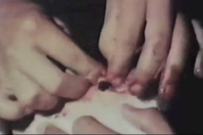 ‘Psychic Surgeons’ Say They Can Operate With Bare Hands