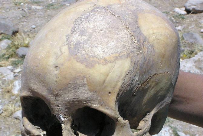8,000-Year-Old Skull With Preserved Brain Matter Found in Norway