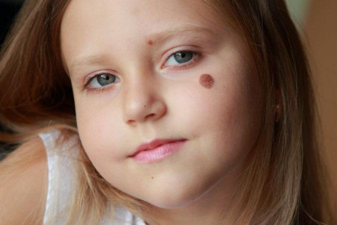 A Theory on How Birthmarks Could Correspond to Wounds From Past Lives