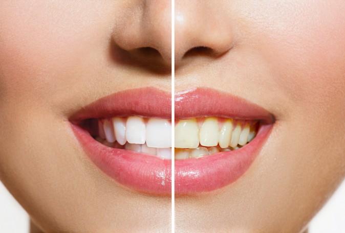 Top 5 Natural Tooth Whiteners