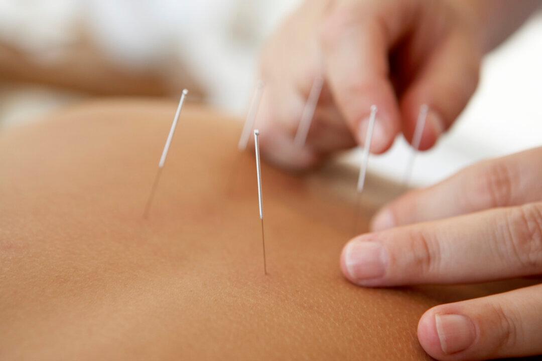 7 Top Reasons to Try Acupuncture