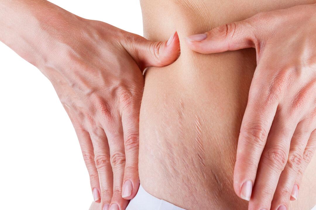Why Do I Have Stretch Marks and What Can I Do About Them?