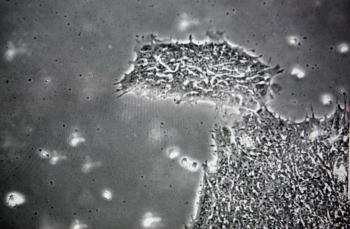 HIV Treatment: Stem Cell Transplant Cures Man of AIDS