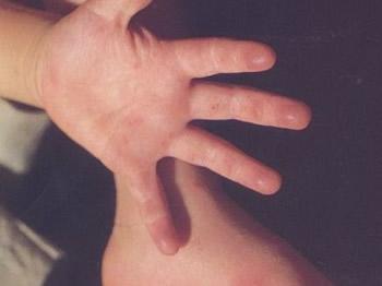 Hand, Foot And Mouth Disease Outbreak in Northeast China