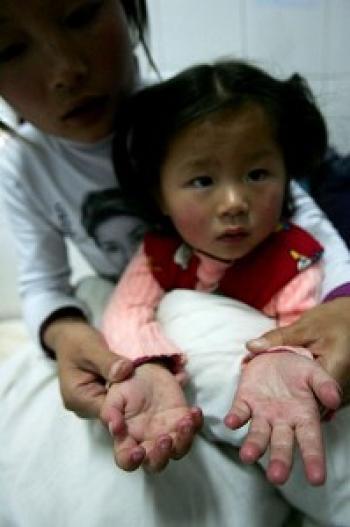 Alarming Outbreak of Mutated Hand, Foot, and Mouth Disease in Guangxi