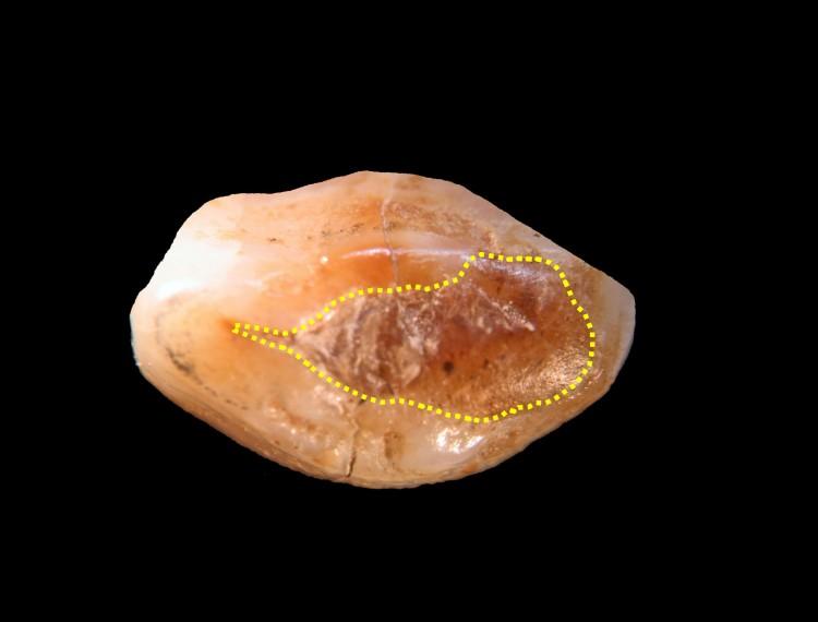Beeswax Filling Found in 6,500-Year-Old Human Tooth