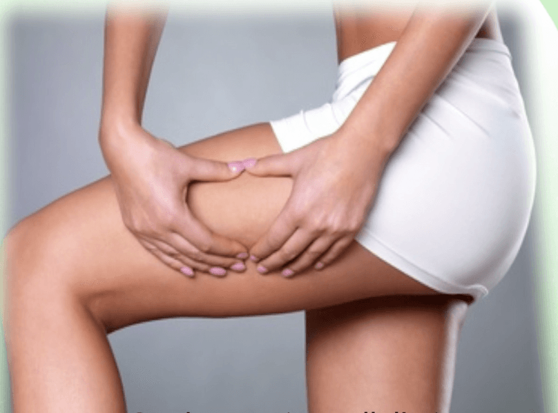Beyond Creams: Tips to Prevent and Treat Cellulite