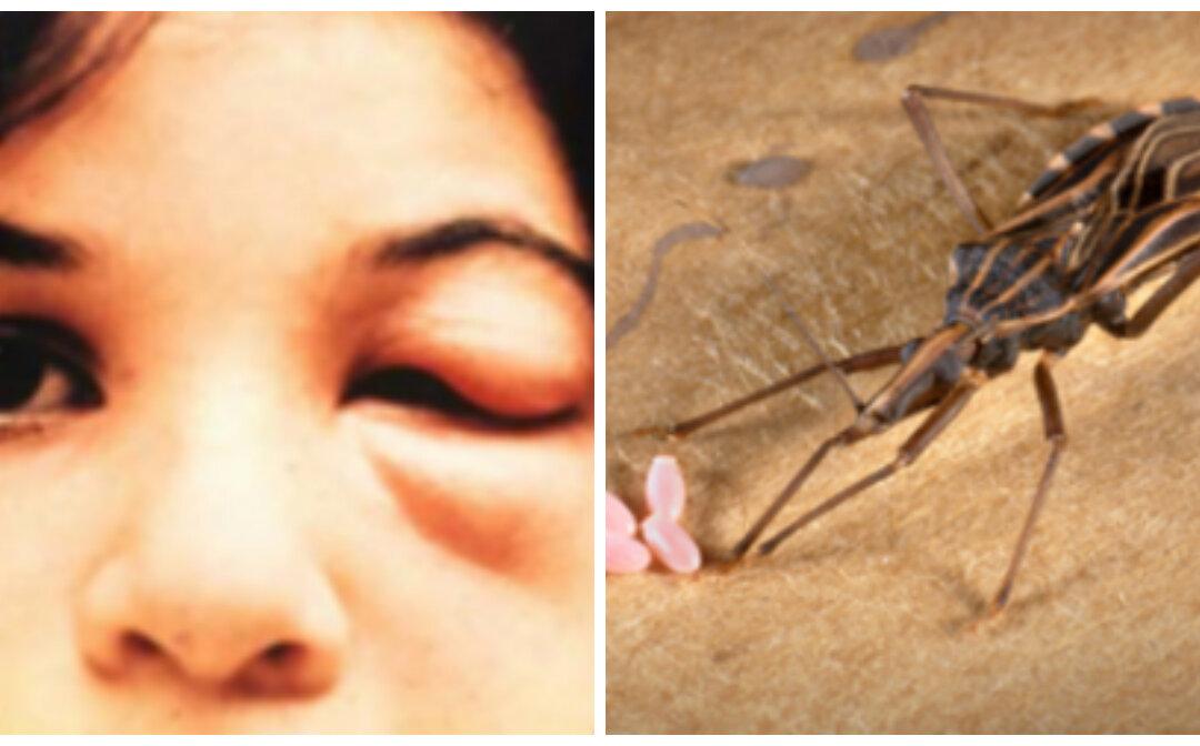 How Deadly Are ‘Kissing Bugs’ Really?