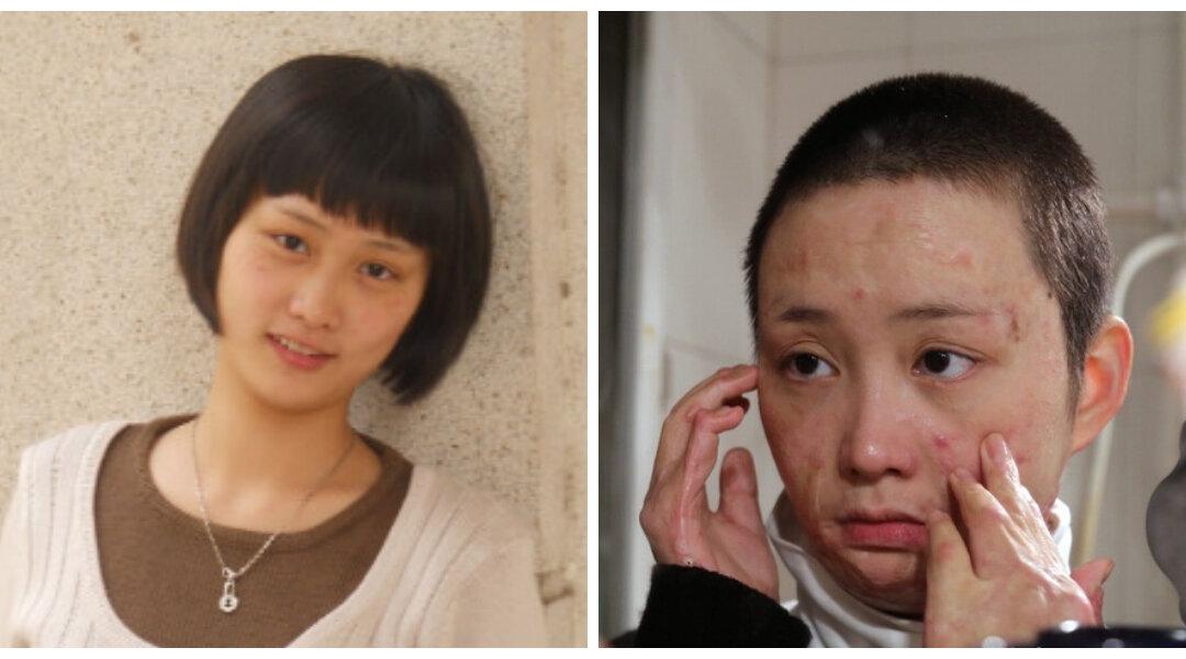 The Struggles of a Chinese Woman Disfigured by a Vengeful Admirer