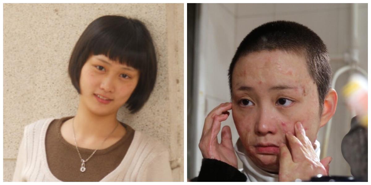 The Struggles of a Chinese Woman Disfigured by a Vengeful Admirer