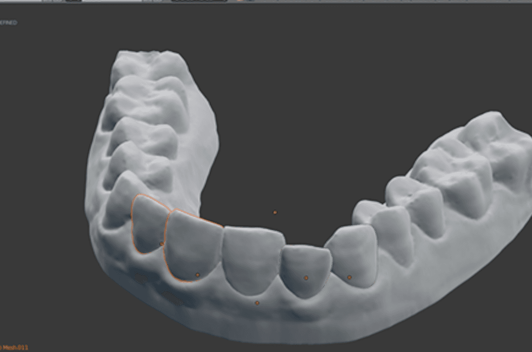 Student 3-D-Prints Own Braces, Saves Almost $8,000