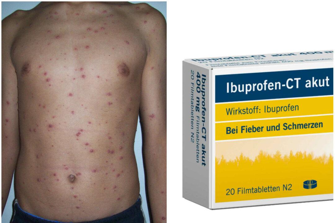 Never Give Ibuprofen or Aspirin to Child With Chicken Pox