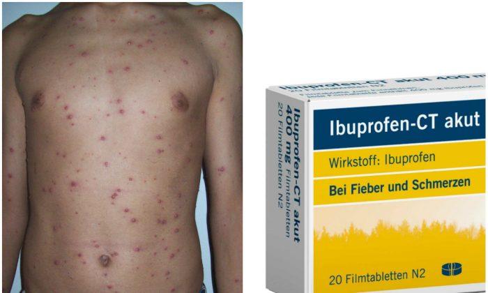Never Give Ibuprofen or Aspirin to Child With Chicken Pox