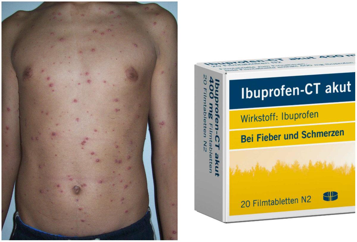 Never Give Ibuprofen or Aspirin to Child With Chicken Pox