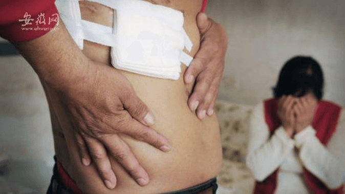 Chinese Man Gets Surgery, Finds His Kidney Missing