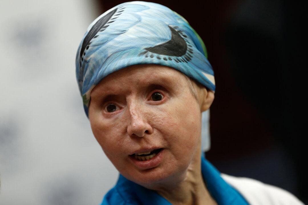 Charla Nash Opens Up Over Recent Facial Transplant Rejection