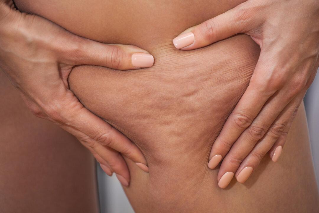 3 Evidence-Based Ways to Reduce Cellulite