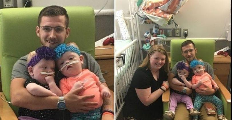 Conjoined Twins Are Doing OK After Separation Surgery: Report