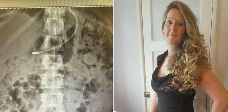 Woman ‘Suffocating’ From Own Waste After Routine Surgery